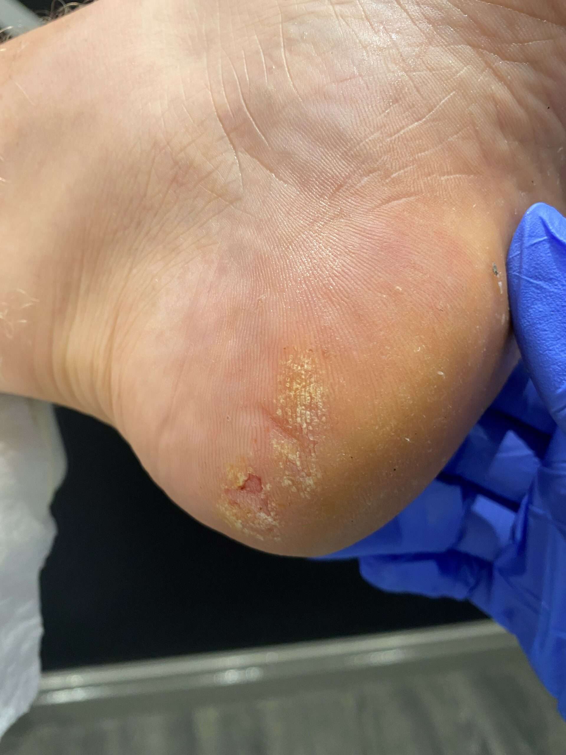Skin: Athlete's Foot (Tinea Pedis) - 26 Foot & Ankle