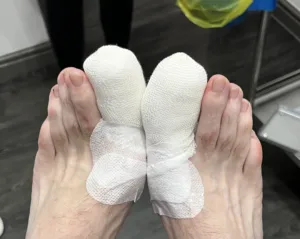 Ingrown toenail surgery